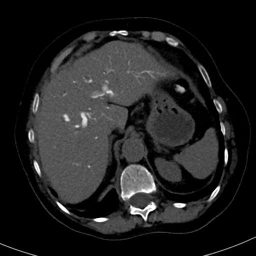File:Ampullary adenocarcinoma (Radiopaedia 34013-35241 AXIAL THICK 16).png