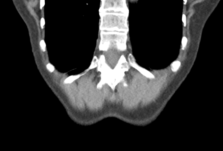 Ampullary adenocarcinoma (Radiopaedia 34013-35241 Coronal 47).png