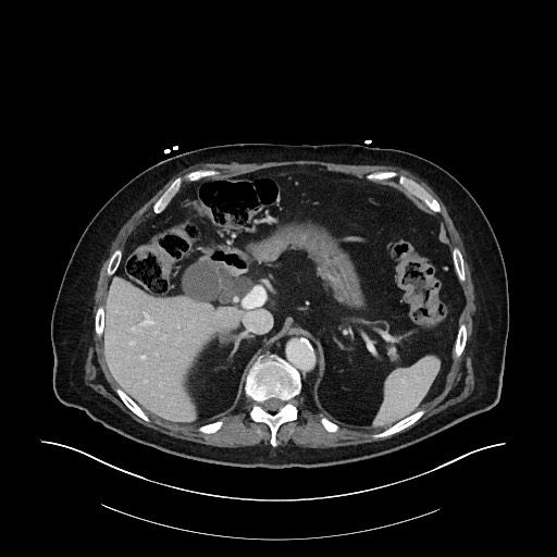 Ampullary adenocarcinoma (Radiopaedia 59373-66734 C 45).jpg