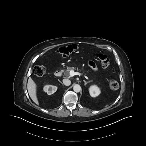 Ampullary adenocarcinoma (Radiopaedia 59373-66734 C 54).jpg