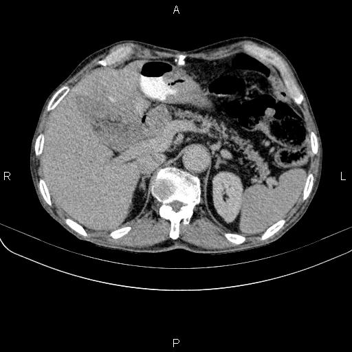 Ampullary adenocarcinoma (Radiopaedia 86093-102033 Axial C+ delayed 31).jpg