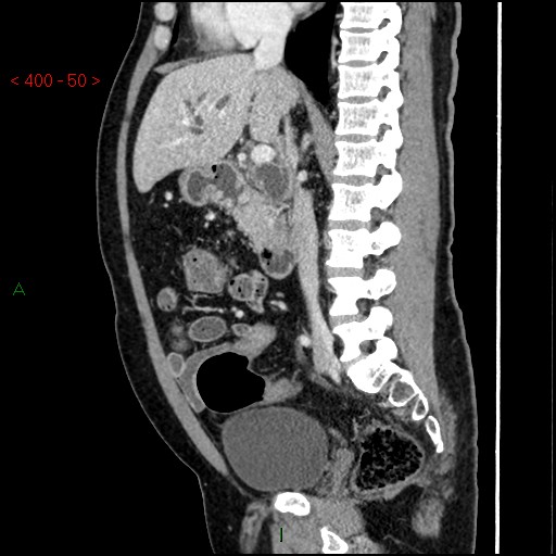 File:Ampullary carcinoma (Radiopaedia 56396-63056 D 49).jpg