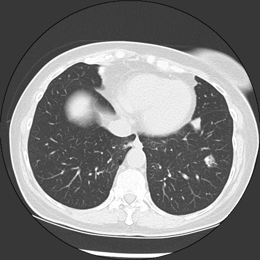 Amyloidosis - bronchial and diffuse nodular pulmonary involvement (Radiopaedia 60156-67744 B 43).jpg