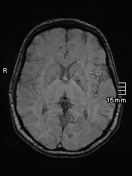 Amyotrophic lateral sclerosis (Radiopaedia 70821-81017 Axial SWI 26).jpg