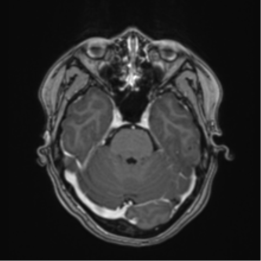 Anaplastic astroblastoma (Radiopaedia 55666-62194 Axial T1 C+ 23).png