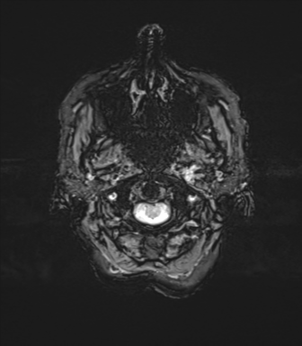 File:Anaplastic astrocytoma (Radiopaedia 86943-103160 Axial SWI 6).png