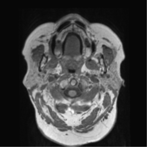 File:Anaplastic astrocytoma IDH wild-type (pseudoprogression) (Radiopaedia 42209-45278 Axial T1 10).png