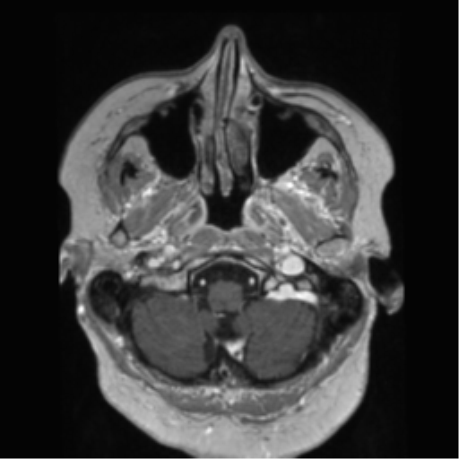 File:Anaplastic astrocytoma IDH wild-type (pseudoprogression) (Radiopaedia 42209-45278 Axial T1 C+ 30).png