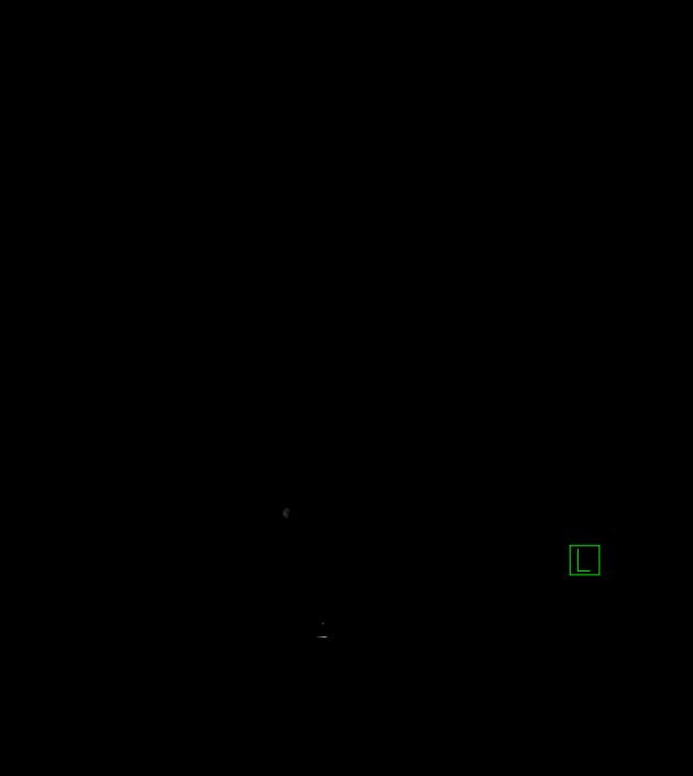 Anaplastic oligodendroglioma (Radiopaedia 79571-92758 C 1).jpg