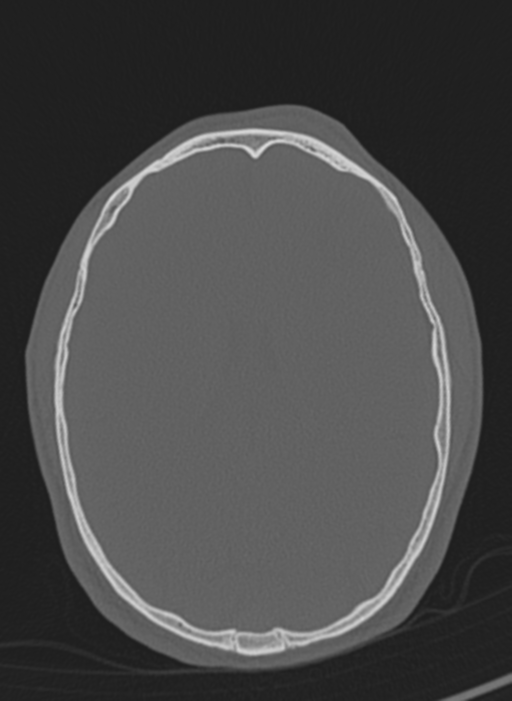 Anaplastic oligodendroglioma with skull fracture (Radiopaedia 74831-85846 Axial bone window 24).png