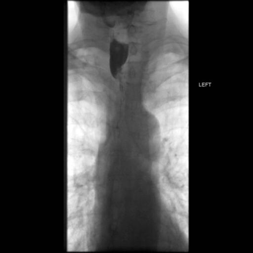 File:Anastomotic stricture post Ivor Lewis esophagectomy (Radiopaedia 47937-52715 Frontal 29).png