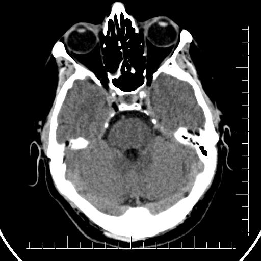 File:Aneurysm of posterior communicating artery (Radiopaedia 20188-20162 Axial non-contrast 14).jpg