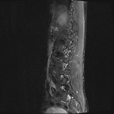 File:Aneurysmal bone cyst T11 (Radiopaedia 29294-29720 Sagittal STIR 3).jpg
