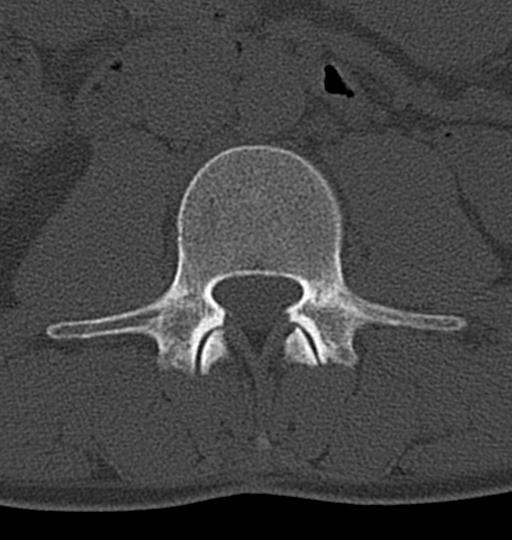 File:Aneurysmal bone cyst T11 (Radiopaedia 29294-29721 Axial bone window 86).jpg