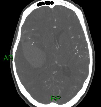 File:Aneurysmal subarachnoid hemorrhage with intra-axial extension (Radiopaedia 84371-99732 A 19).jpg