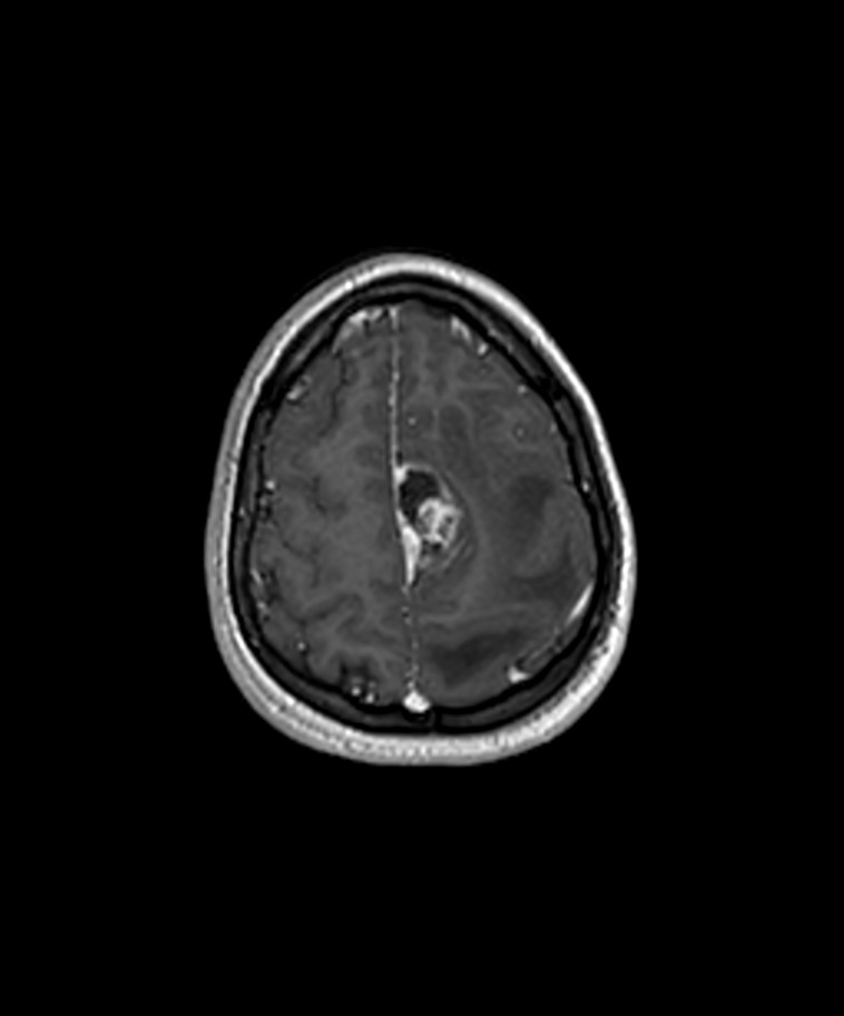 Angiomatous meningioma (Radiopaedia 79459-92577 Axial T1 C+ 3D ISO 50).jpg