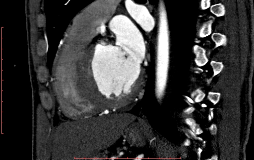 Anomalous left coronary artery from the pulmonary artery (ALCAPA) (Radiopaedia 70148-80181 C 149).jpg