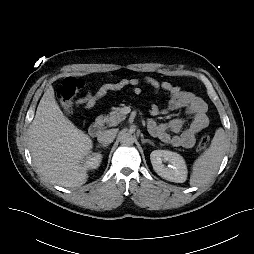 File:Anomalous origin of the left coronary artery with malignant course (Radiopaedia 77842-90126 Axial non-contrast 39).jpeg