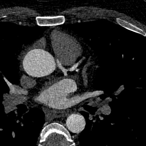 File:Anomalous origin of the left coronary artery with malignant course (Radiopaedia 77842-90126 C 22).jpeg