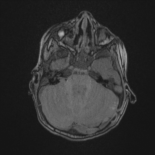 Anoxic brain injury (Radiopaedia 79165-92139 Axial MRA 59).jpg