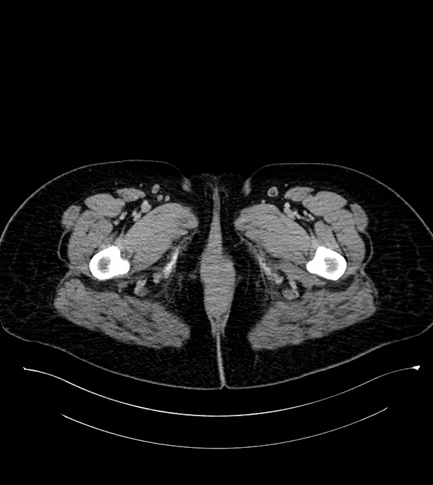 Anterior abdominal wall CSF pseudocyst (CSFoma) (Radiopaedia 79453-92571 A 100).jpg