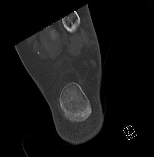 Anterior calcaneal process fracture (Radiopaedia 63353-71943 Axial bone window 119).jpg