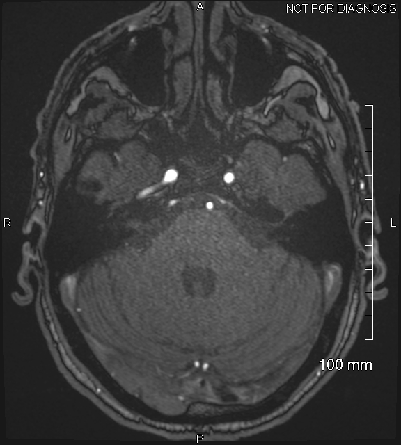 Anterior cerebral artery aneurysm (Radiopaedia 80683-94127 Axial MRA 58).jpg