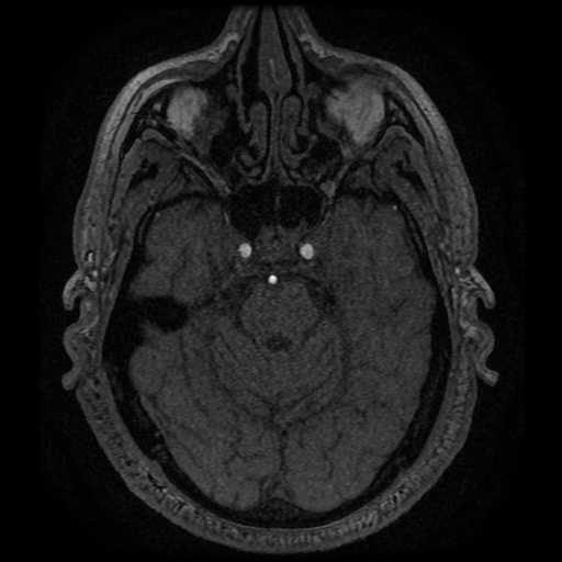 Anterior cerebral artery infarction (Radiopaedia 46794-51323 Axial MRA 46).jpg
