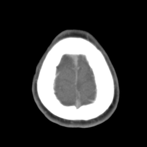 File:Anterior cerebral artery territory infarct (Radiopaedia 39327-41581 B 10).png