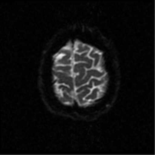 File:Anterior cerebral artery territory infarct (Radiopaedia 39327-41584 Axial DWI 49).png