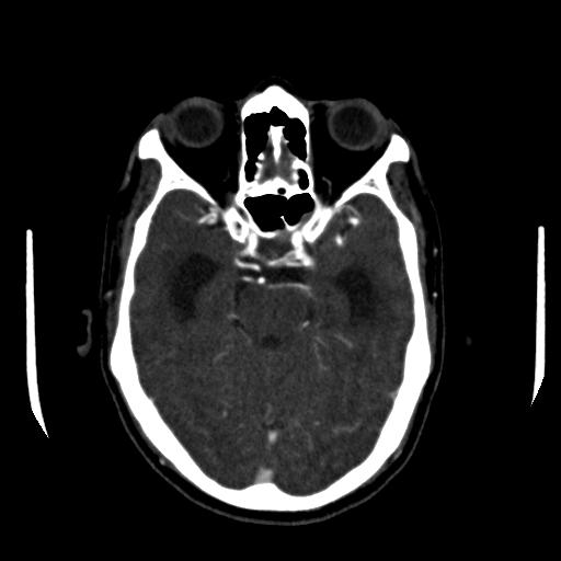 File:Anterior communicating artery aneurysm (Radiopaedia 16633-16335 A 15).jpg