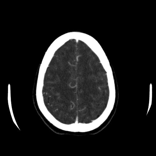 File:Anterior communicating artery aneurysm (Radiopaedia 16633-16335 A 36).jpg