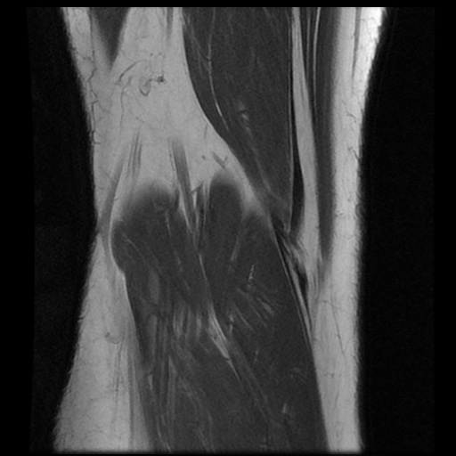 File:Anterior cruciate ligament avulsion fracture (Radiopaedia 58939-66193 Coronal T1 18).jpg