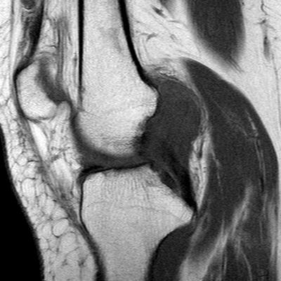 Anterior cruciate ligament mucoid degeneration (Radiopaedia 60853-68633 Sagittal T1 13).jpg