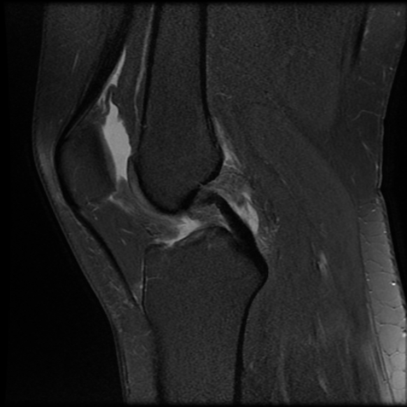 File:Anterior cruciate ligament tear, Wrisberg rip and bucket-handle tear of medial meniscus (Radiopaedia 75872-87266 Sagittal PD fat sat 14).jpg