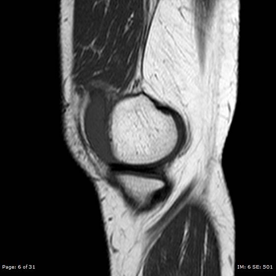 File:Anterior cruciate ligament tear (Radiopaedia 70783-80964 Sagittal T1 6).jpg