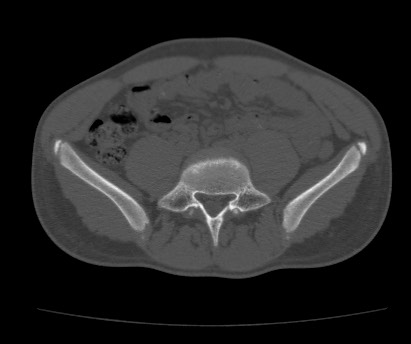 Anterior inferior iliac spine avulsion fracture (Radiopaedia 81312-94999 Axial bone window 18).jpg