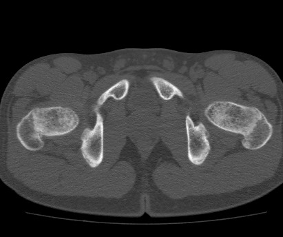 Anterior inferior iliac spine avulsion fracture (Radiopaedia 81312-94999 Axial bone window 62).jpg