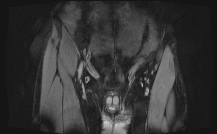 Anterior inferior iliac spine avulsion fracture (Radiopaedia 81312-95000 G 100).jpg