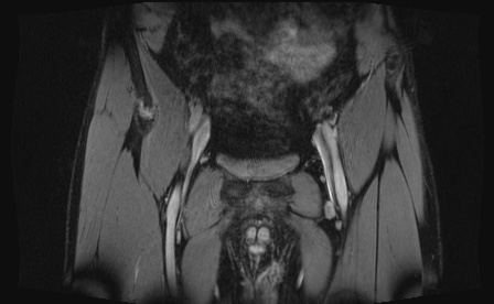 Anterior inferior iliac spine avulsion fracture (Radiopaedia 81312-95000 G 89).jpg