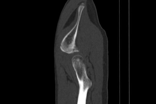 Anterior inferior iliac spine avulsion injury (Radiopaedia 88666-105376 Sagittal bone window 82).jpg