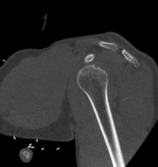 Anterior shoulder dislocation with Hill-Sachs and bony Bankart lesions (Radiopaedia 40424-42974 Sagittal bone window 21).png