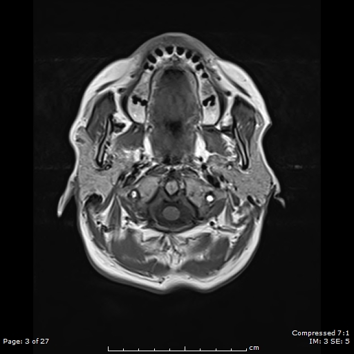 File:Anterior temporal lobe perivascular space (Radiopaedia 88283-104914 Axial T1 3).jpg