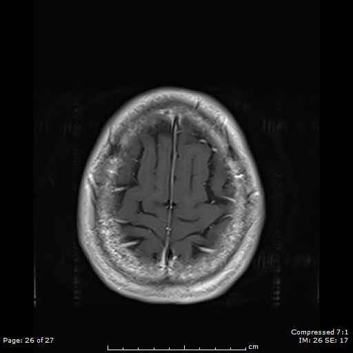 File:Anterior temporal lobe perivascular space (Radiopaedia 88283-104914 Axial T1 C+ 26).jpg