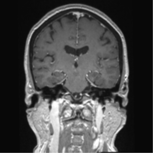 Anterior temporal pole cysts (Radiopaedia 46629-51102 Coronal T1 C+ 81).png