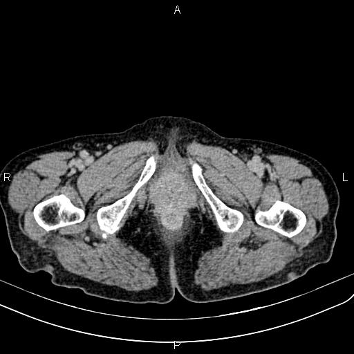 File:Aortic aneurysm and Lemmel syndrome (Radiopaedia 86499-102554 Axial C+ delayed 86).jpg