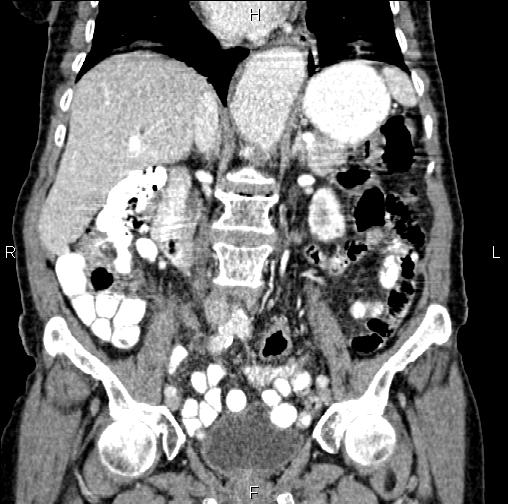 Aortic aneurysm and Lemmel syndrome (Radiopaedia 86499-102554 C 30).jpg