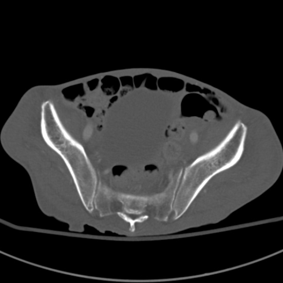 Aortic aneurysm with spinal destruction (Radiopaedia 42301-45410 Axial bone window 89).jpg