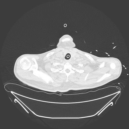 Aortic arch aneurysm (Radiopaedia 84109-99365 Axial lung window 32).jpg