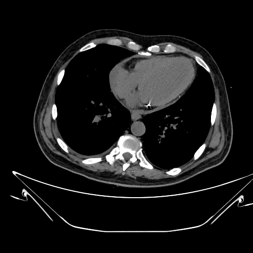 Aortic arch aneurysm (Radiopaedia 84109-99365 Axial non-contrast 188).jpg